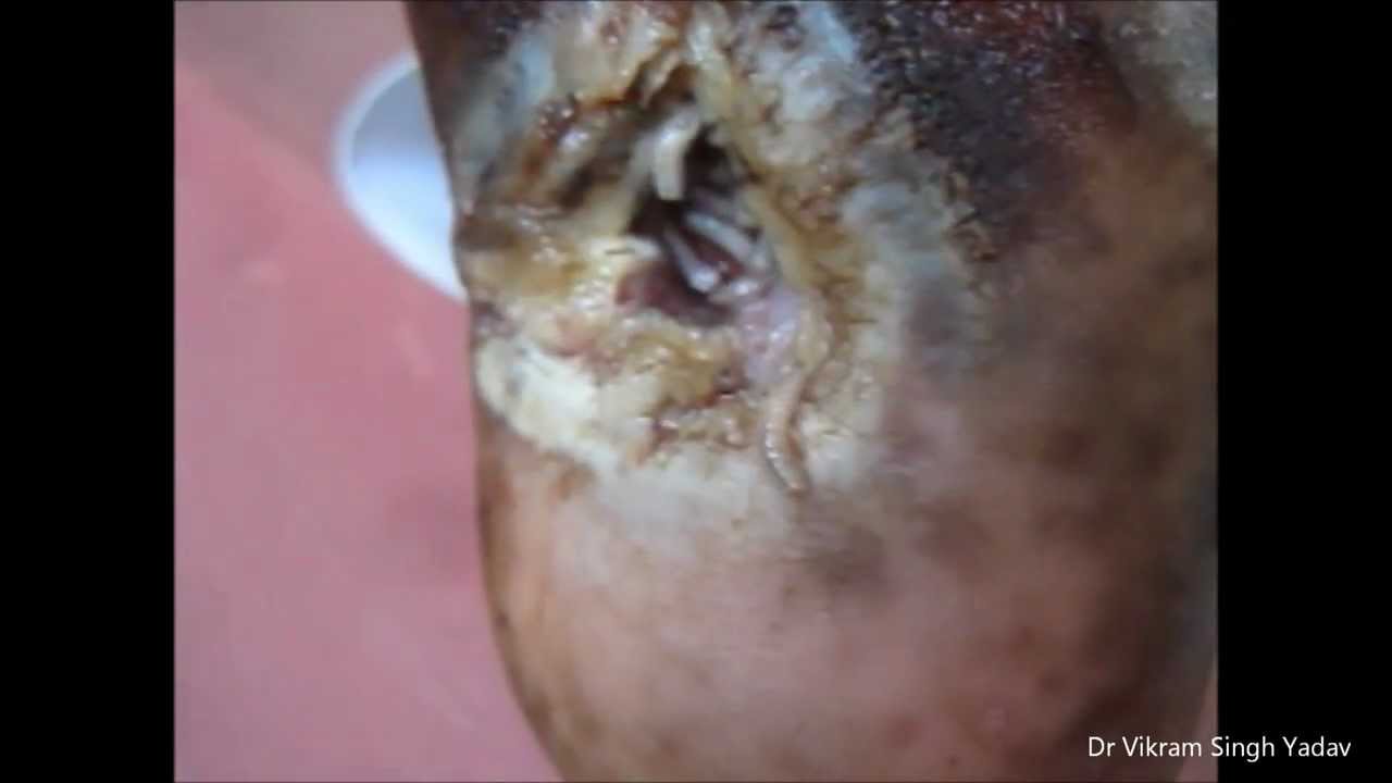 Maggots Inside Wound - YouTube