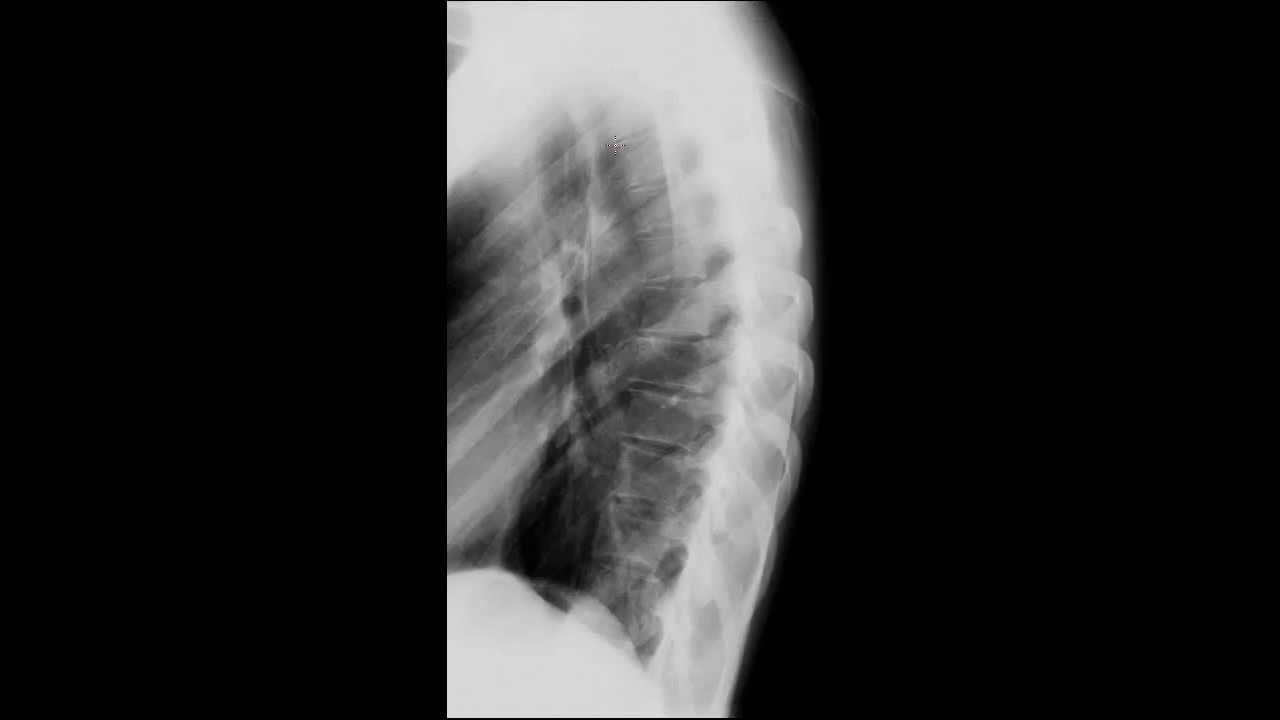 Thoracic Spine Radiology Tutorial YouTube