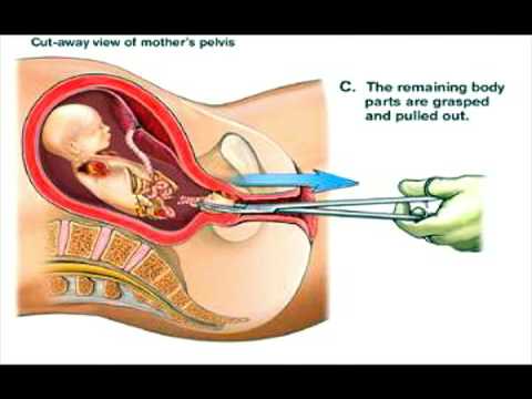 Abortion Illustrated / 23 Weeks Gestational Age / Video ... 7 months pregnant diagram 