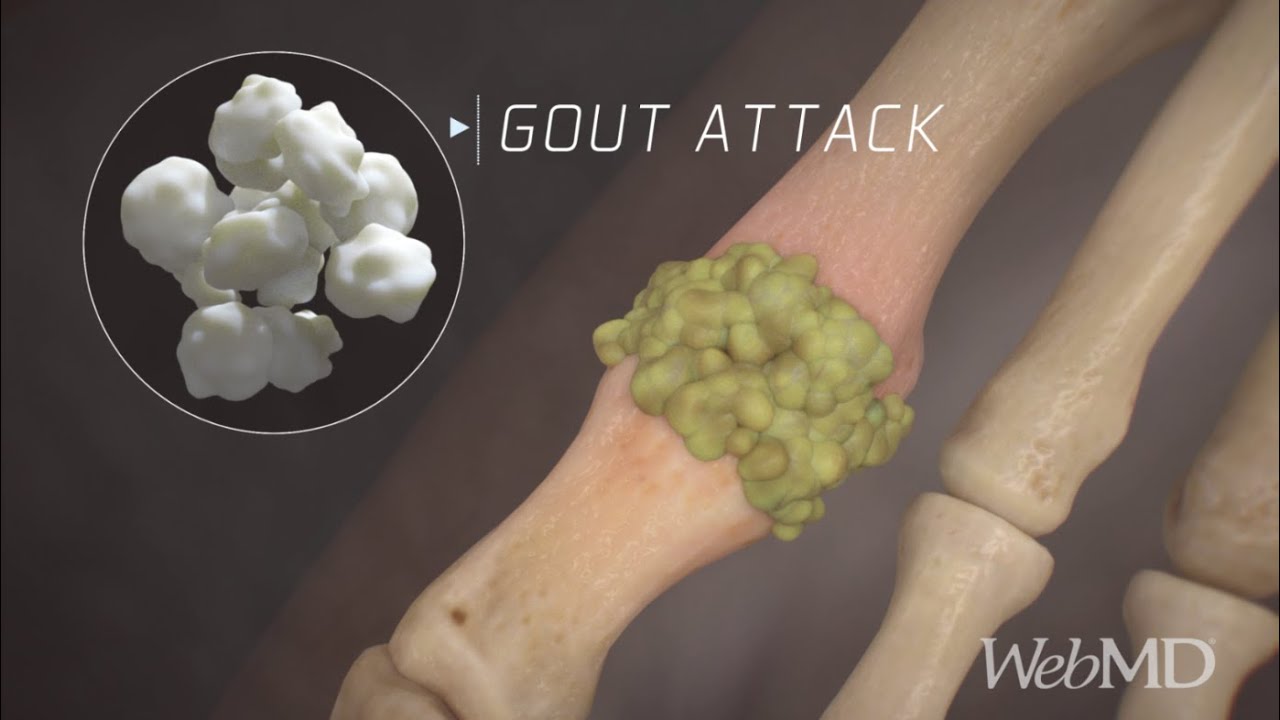 Free gout articles.html.