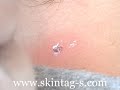 Skin Tag Removal in 15 Mins @ Home!