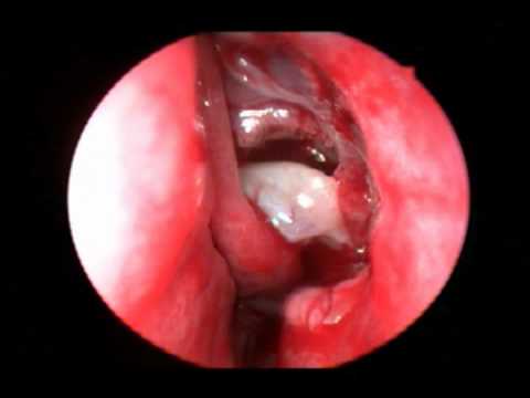 Endoscopic Sinus Surgery - procedure, recovery, pain, complications, time, infection, cells, risk