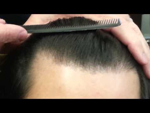 Hair Transplant hair line results by Dr. Dan McGrath, Austin, TX