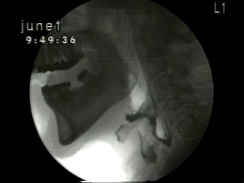 The ABC's of videofluoroscopy of swallowing - YouTube