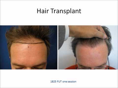 New Hair Transplant Technology