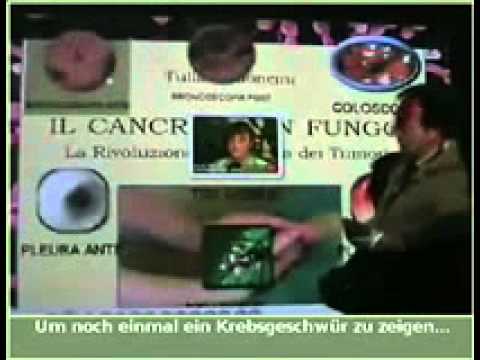 Dr Tullio Simoncini Krebs ist ein Candida Pilz, heilbar99% mit Natriumhydrogencarbonat part1 2