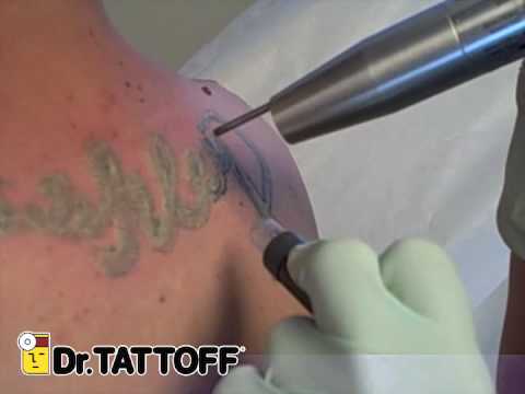 removal of tattoo upper back name tattoo removed at dr removal of tattoo upper back name tattoo removed at dr