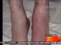 Michael Jackson's - Hole In Leg Injection Marks Revealed 