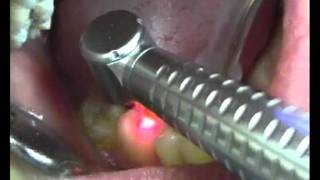 Лечение кариеса эрбиевым лазером, 36 зуб
