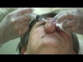 Rhinophyma Excision by Janjua Facial Surgery