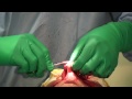 Rhinophyma Excision by Janjua Facial Surgery