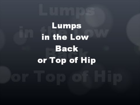 Lumps in Low Back, Top of Hip - YouTube