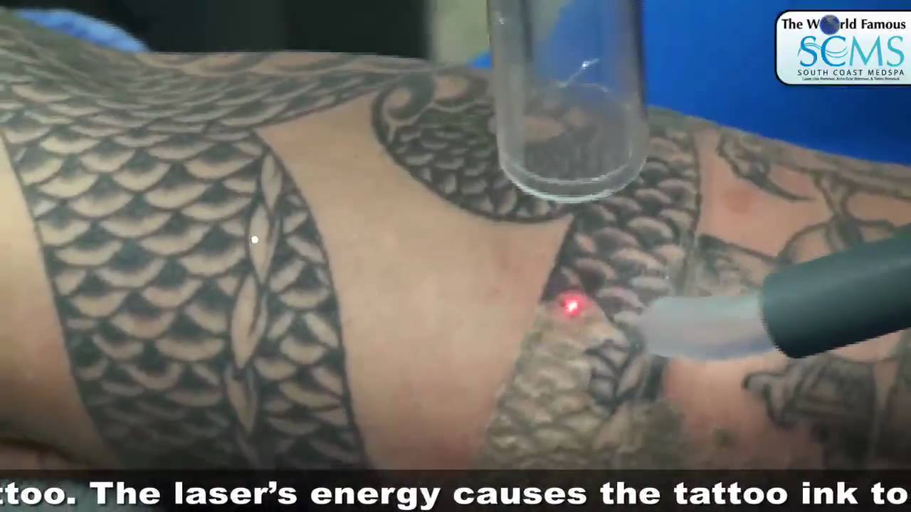 Tattoo Removal Cream doesn't work Laser Does! - YouTube