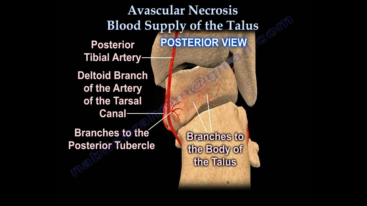 Talus fracture ,Avascular Necrosis, Blood Supply - Everything You Need
