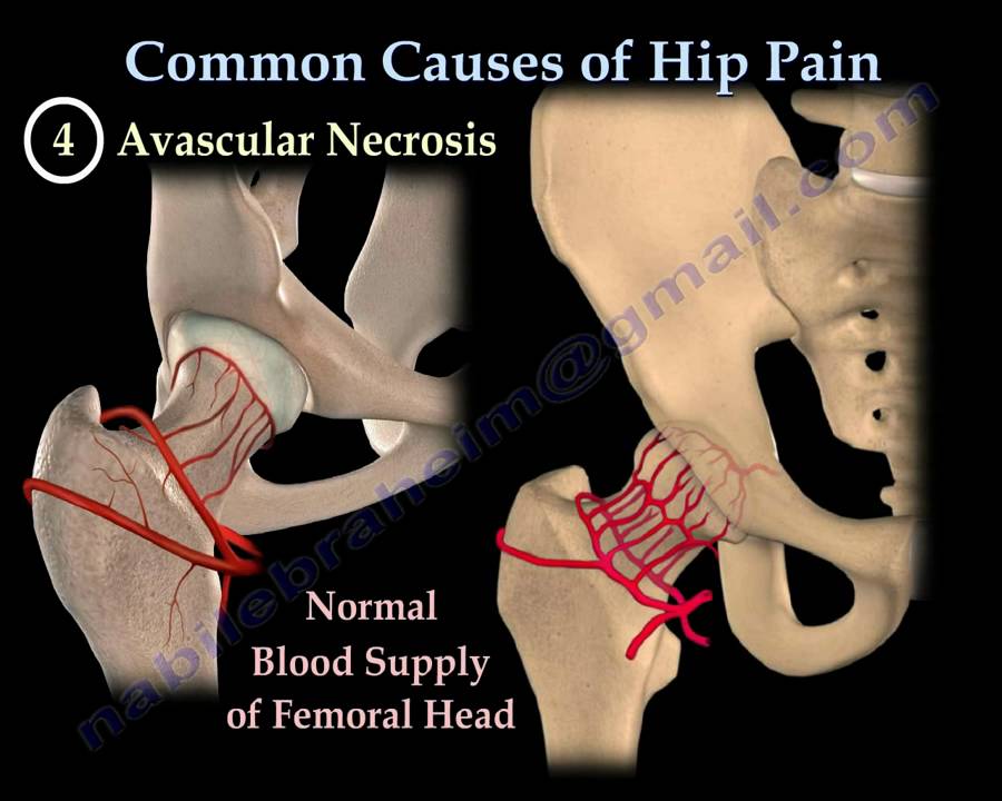 HIP PAIN ,COMMON CAUSES- Everything You Need To Know - Dr. Nabil