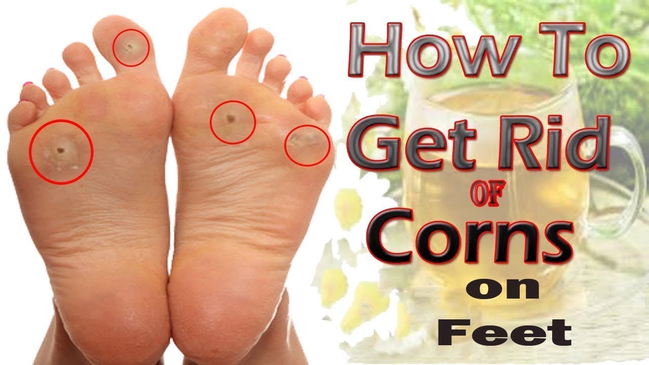get rid of corns fast