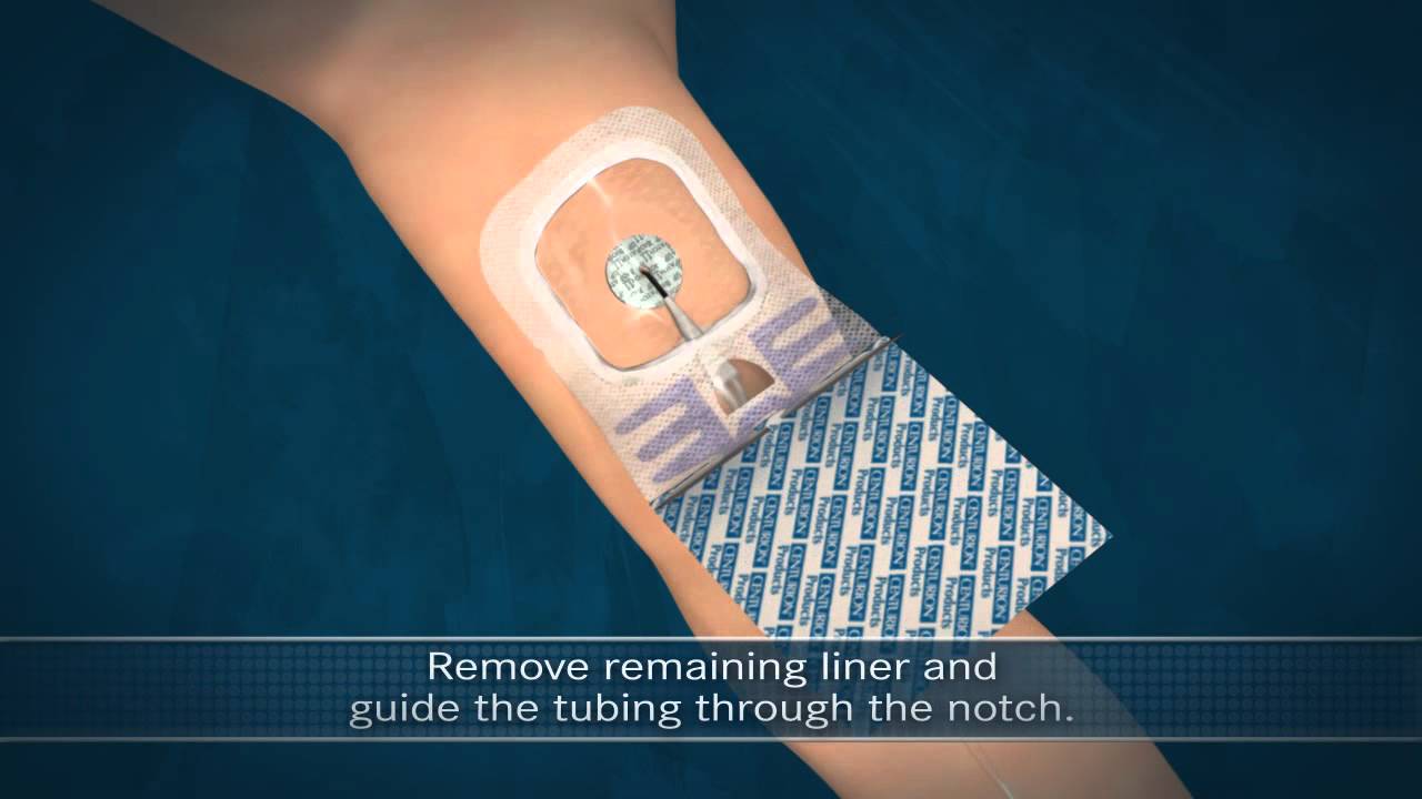 WMHJesup Sorbaview dressing change YouTube