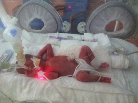 Born at 25 Weeks: Micro-Preemie Documentary - YouTube