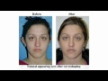 Video: Plastic Surgery - otoplasty