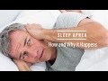 Dr. Avi Weisfogel | Dr. Avi Weisfogel Sleep Apnea