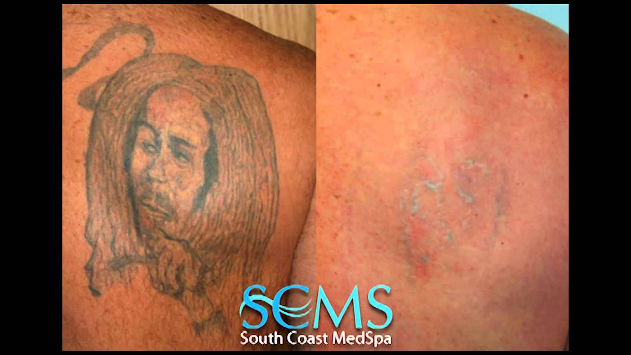 Laser Tattoo Removal Orange County Before/After - YouTube