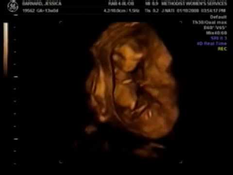 13 week 4d ultrasound pictures