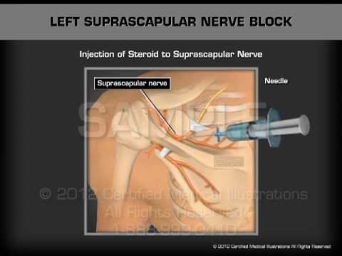 Left Suprascapular Nerve Block - YouTube