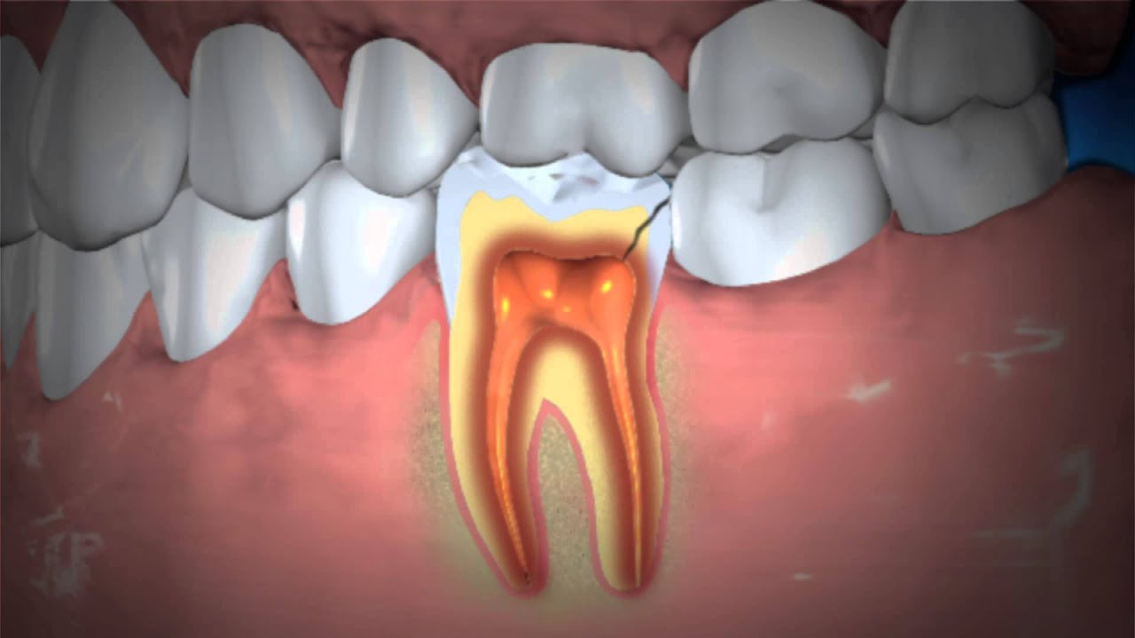 Treatment of Abscessed Teeth - YouTube