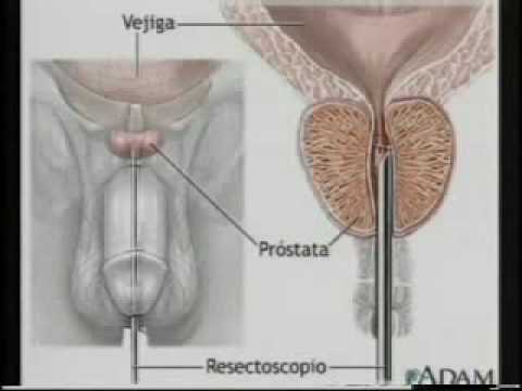 Estim+Prostate prostate http www traitement prostate com anatomie de la prostate ...