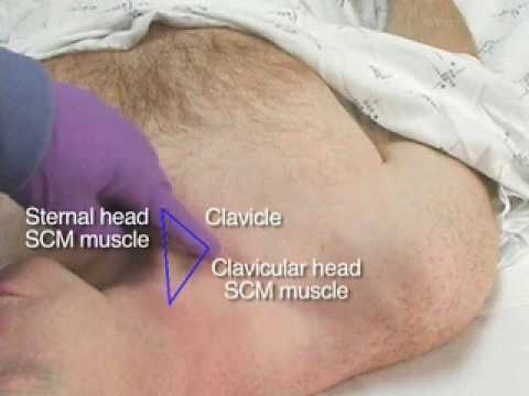 Centeral venous cath. (internal jugular vein).wmv1 - YouTube