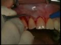 Recession Treatment: Gingival Graft (Tunnel Technique) / Greffe Gingivale (Conjonctive)