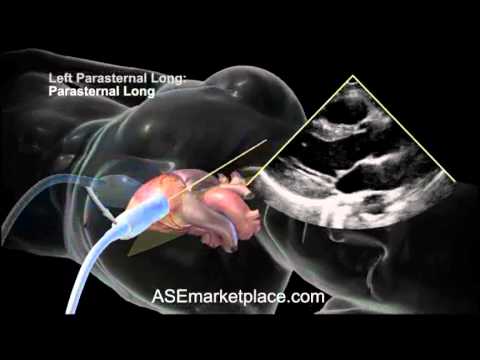 How to do a Basic Transthoracic Echocardiogram: Transducer Position and