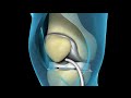 3D MEDICAL ANIMATION Total Knee Joint Replacement Surgery
