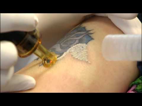Fox News - New Procedure Drastically Cuts Tattoo Removal Time ...