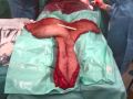 Abdominoplasty  for the massive weight loss patient