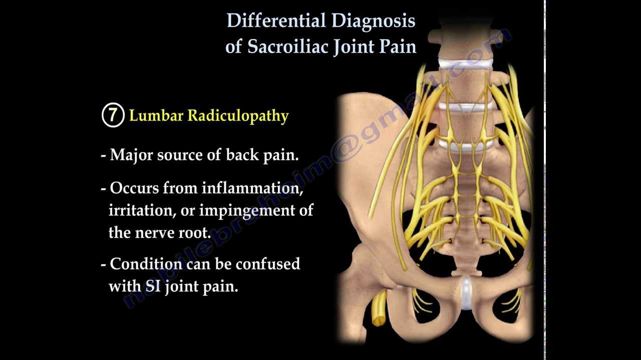 Differential Diagnosis of SI Joint Pain - Everything You Need To Know