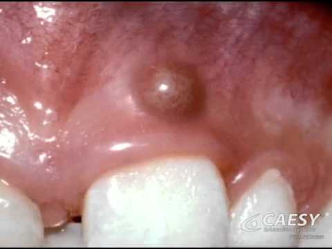 abscess gum periodontal drain gums exam tooth mouth pus pimple infection teeth swelling