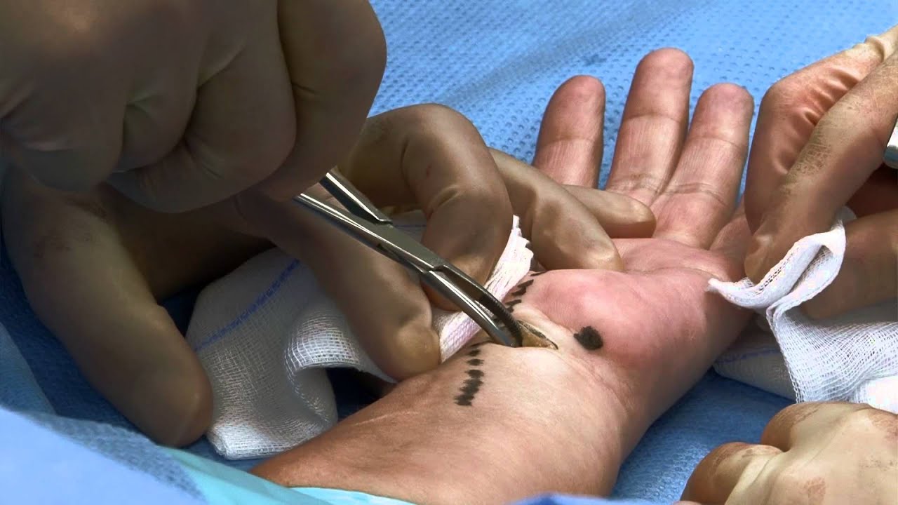 Carpal Tunnel Surgery >> Endoscopic carpal tunnel surgery . Carpale tunnel syndroom ... Carpal Tunnel Surgery >> Endoscopic carpal tunnel surgery . Carpale tunnel syndroom ...