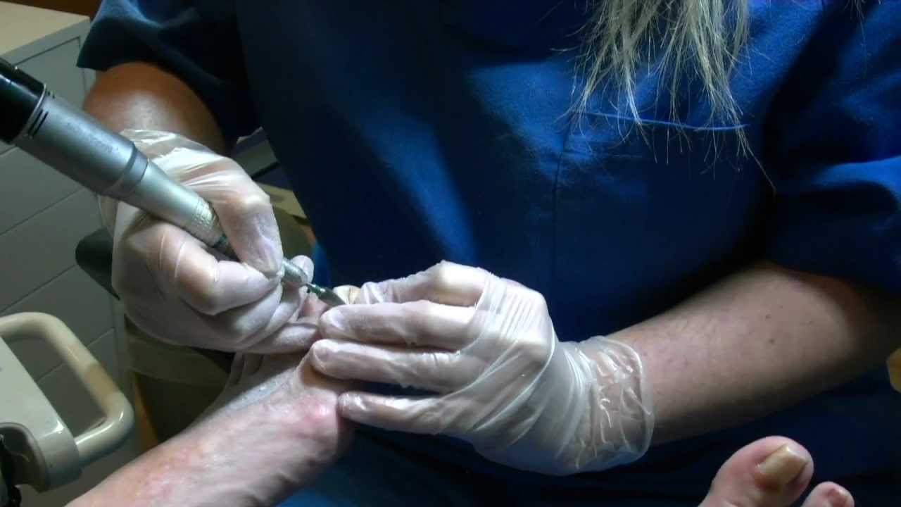 Las medicinas contra los hongos del perineo