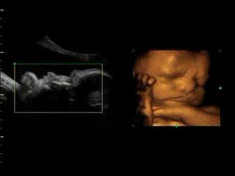 3d ultrasound pictures of twins. Ultimate Ultrasound at Fetal