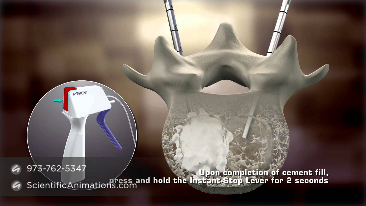 Bone Cement Procedure Spine Animation YouTube