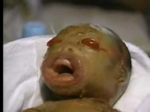 baby with harlequin ichthyosis - YouTube