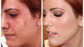 CÓMO CORREGIR ROJECES (ESPECIAL ANGIOMA) CON MAQUILLAJE