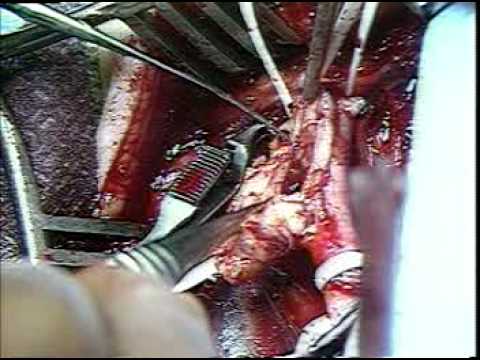 Carotid Endarterectomy Patch Graft