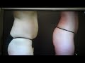 Video: Smartlipo of Abdomen and Hips