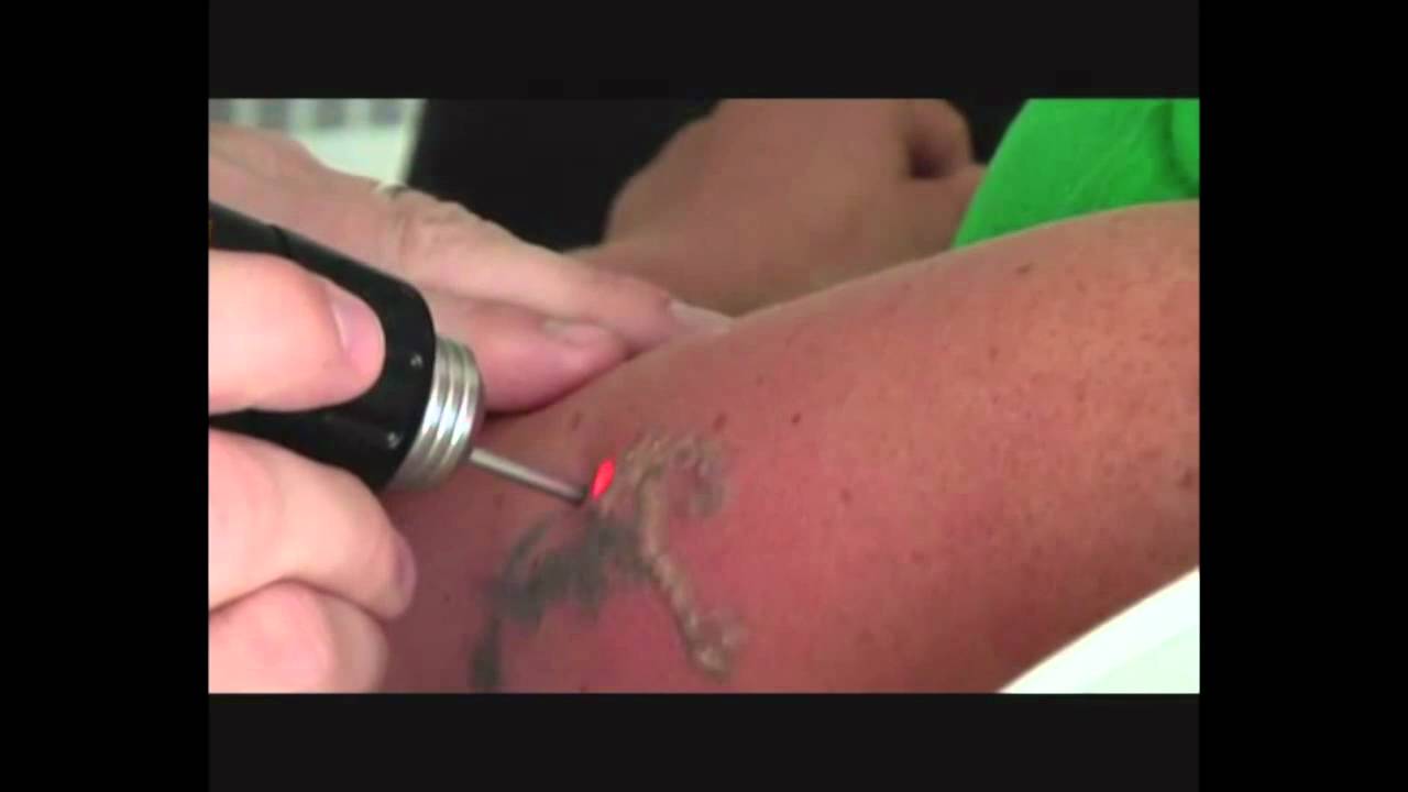 asclepion tattoostar laser tattoo removal youtube asclepion tattoostar laser tattoo removal youtube