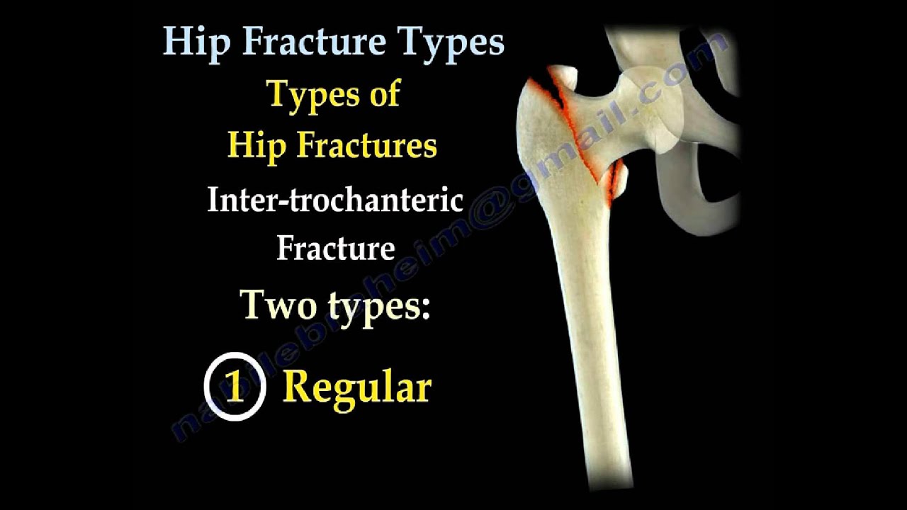 Hip Fractures, Types and fixation - Everything You Need To Know - Dr