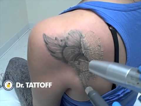 ... Tattoo Removal - Before and after tattoo removal on shoulder - YouTube