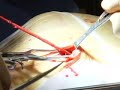 Coronary Bypass Surgery - MedStar Union Memorial