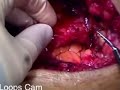 Coronary Bypass Surgery - MedStar Union Memorial